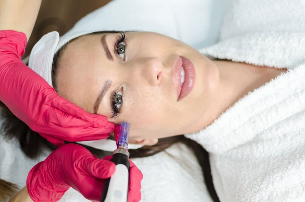 Microneedling San Diego 2
